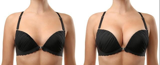 Breast Augmentation Turkey Before & After