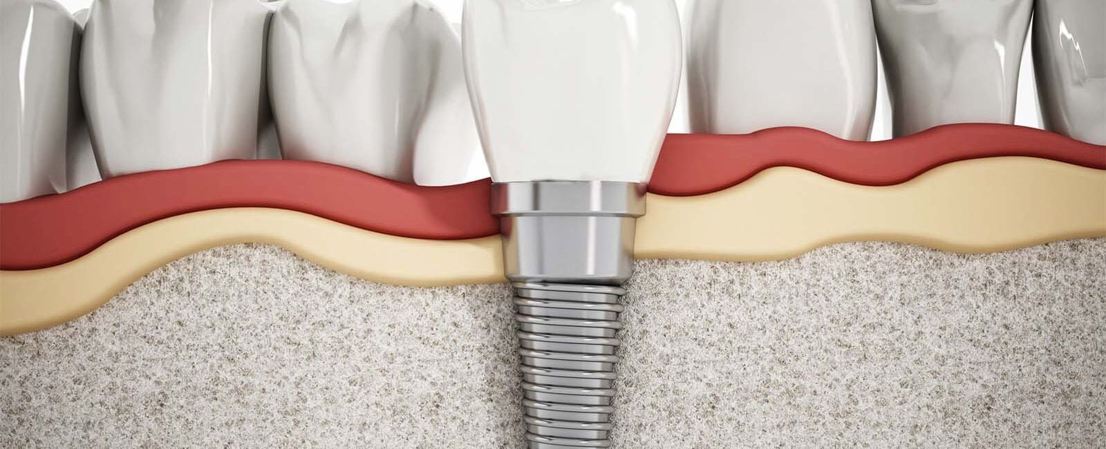Dental Implants Turkey
