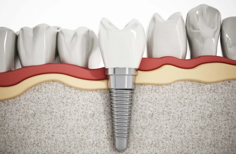 Dental Implants Turkey
