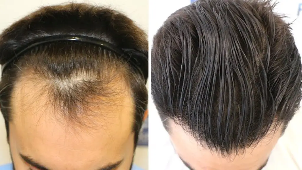 Hair Transplant Before & After