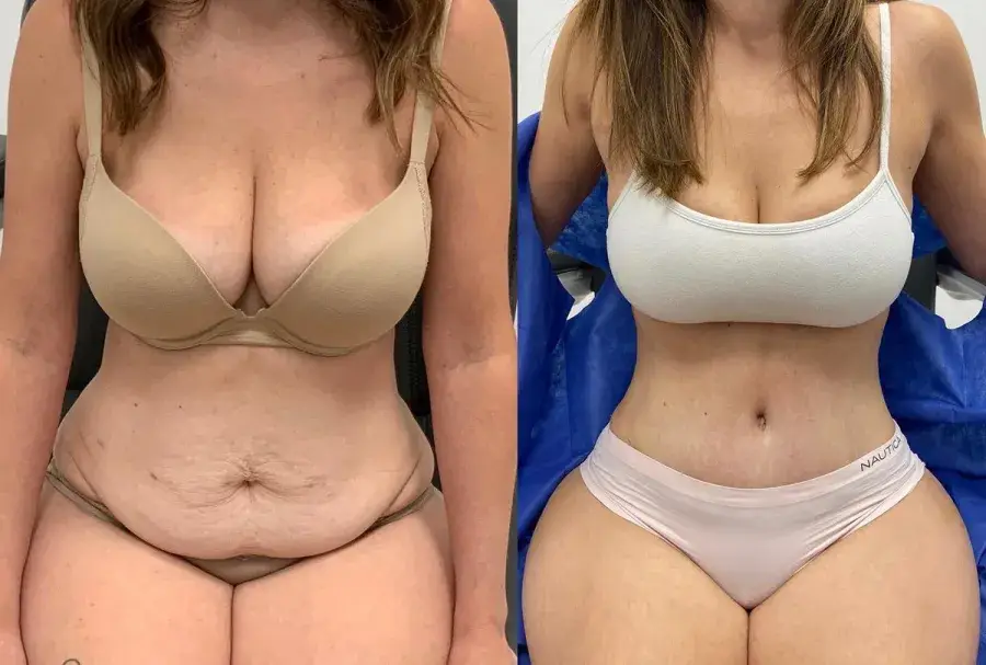 Mommy Makeover Before & After