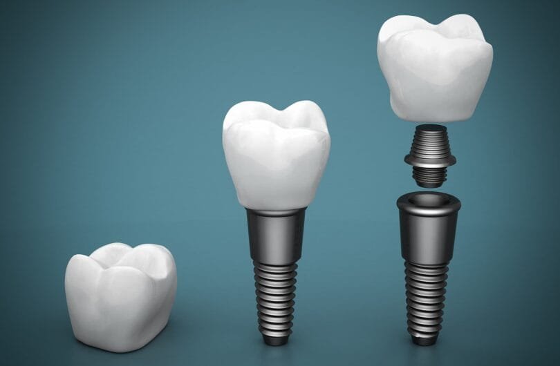 Guide to Dental Implants in Turkey – Cost, Benefits, and Comparison with the UK