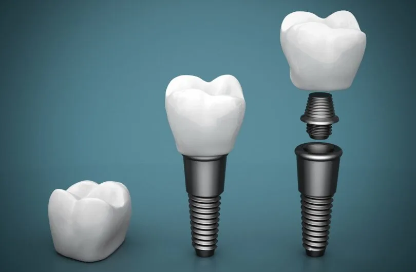 Guide to Dental Implants in Turkey – Cost, Benefits, and Comparison with the UK