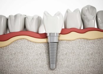 Dental Implants Turkey
